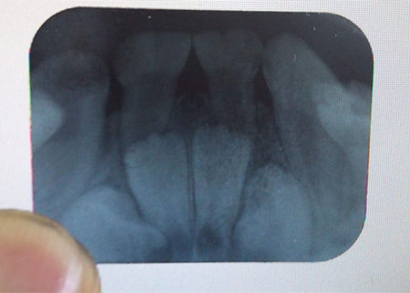 看牙齒為什么要拍片？