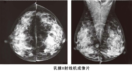 乳腺鉬鈀檢查系統(tǒng)成像